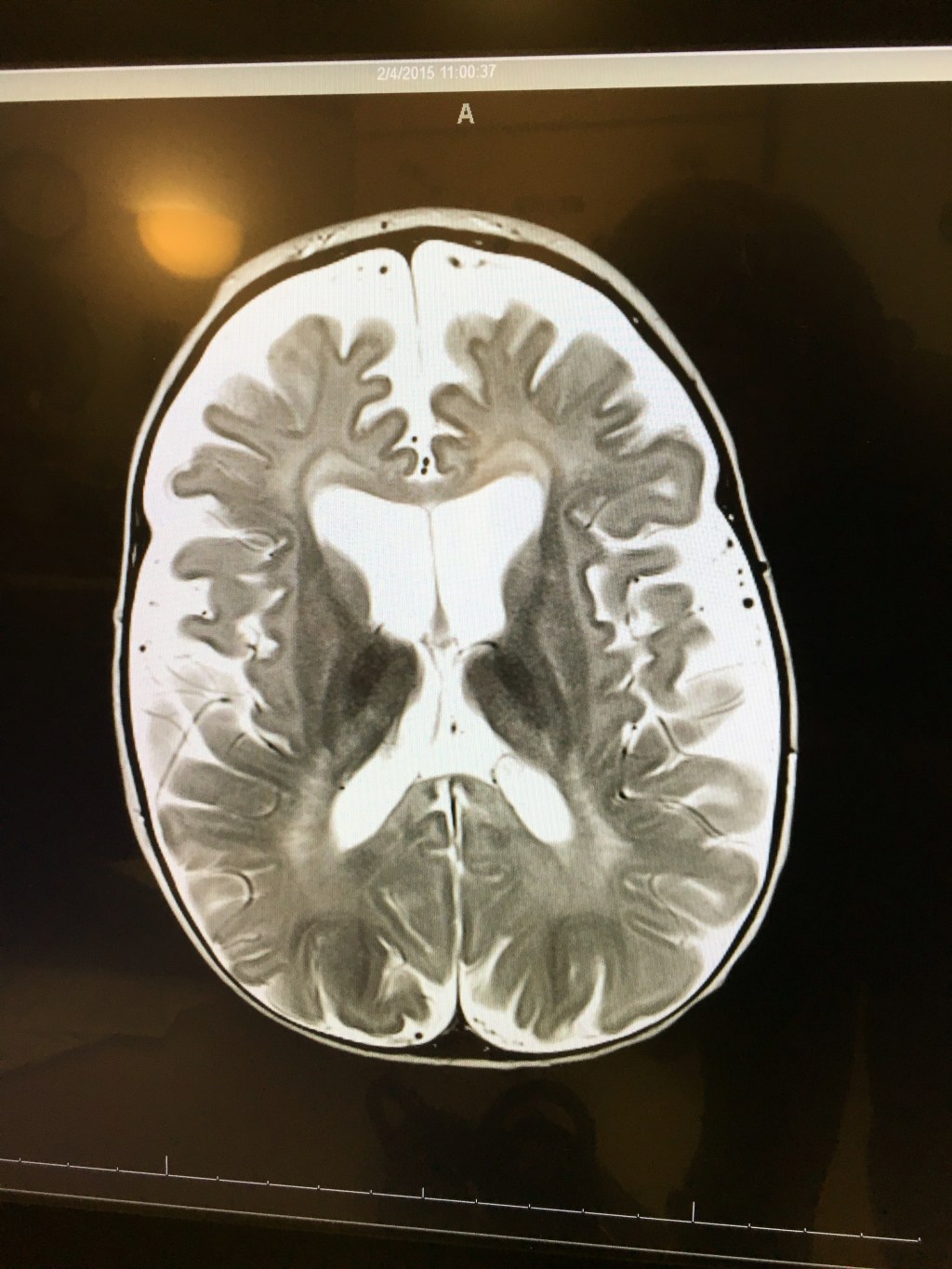 One Year Ago: The First&nbsp;MRI